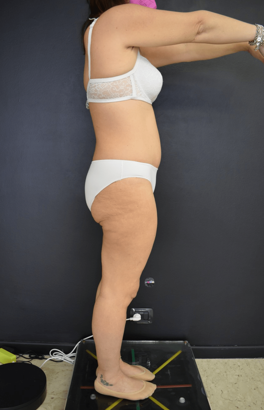 Addominoplastica Catania Majani dpost