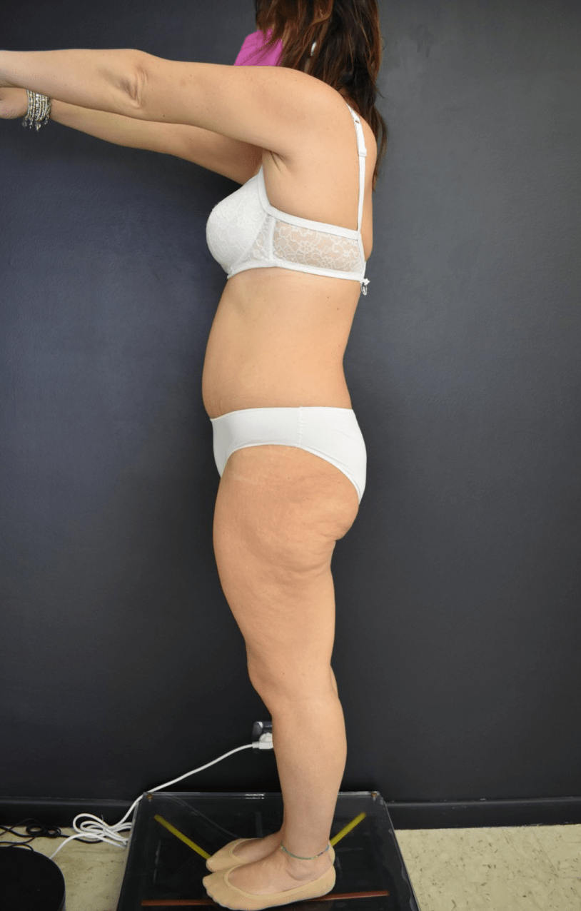 Addominoplastica Catania Majani sxpost