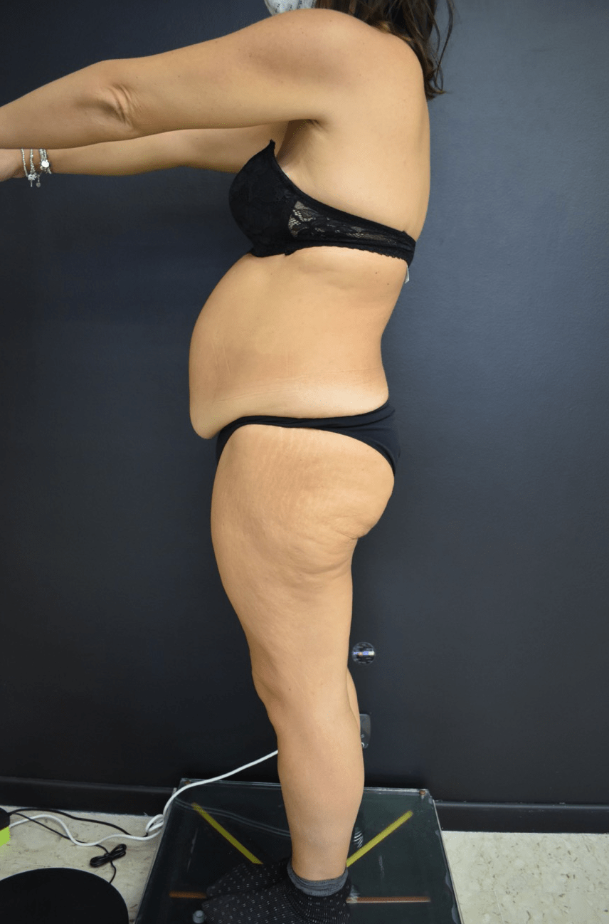 Addominoplastica Catania Majani sxpre