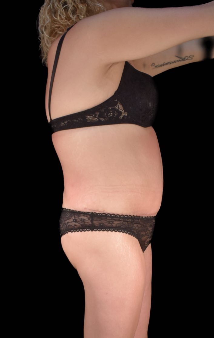 Addominoplastica MIAS dopo