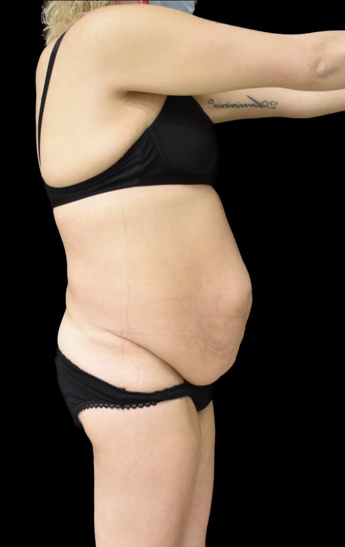 Addominoplastica MIAS prima