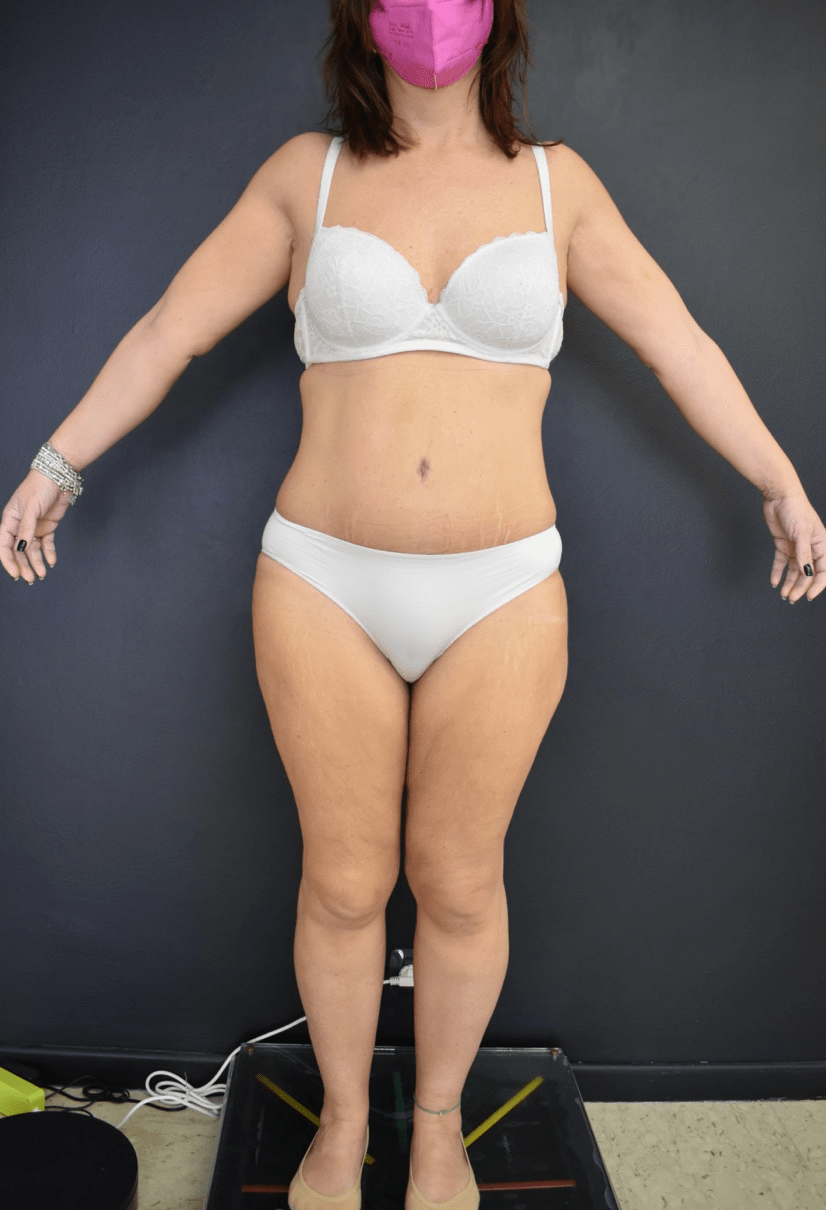 Addominoplastica Majani Catania apost