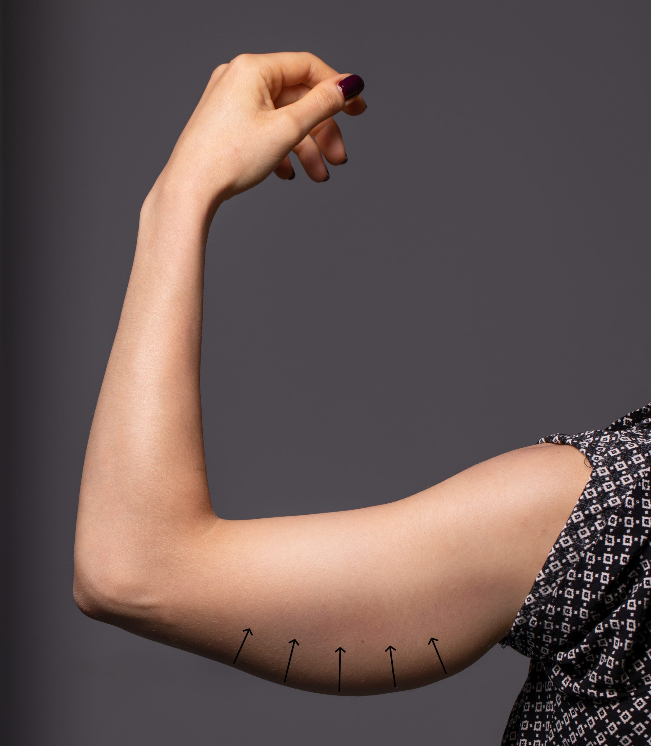 A young woman’s arm is seen up close before a brachioplasty pr