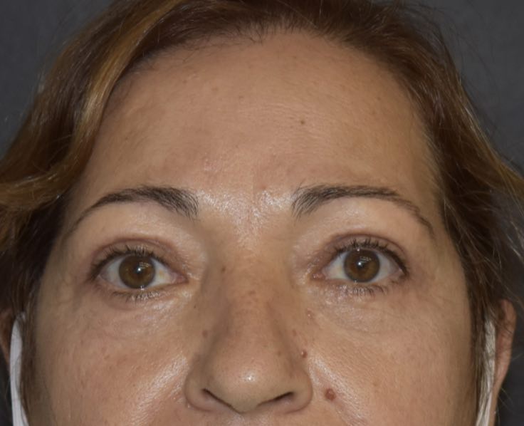 Blefaroplastica supero-inferiore a Catania