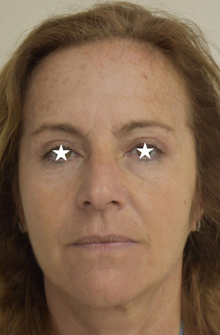 Blefaroplastica laser a Catania