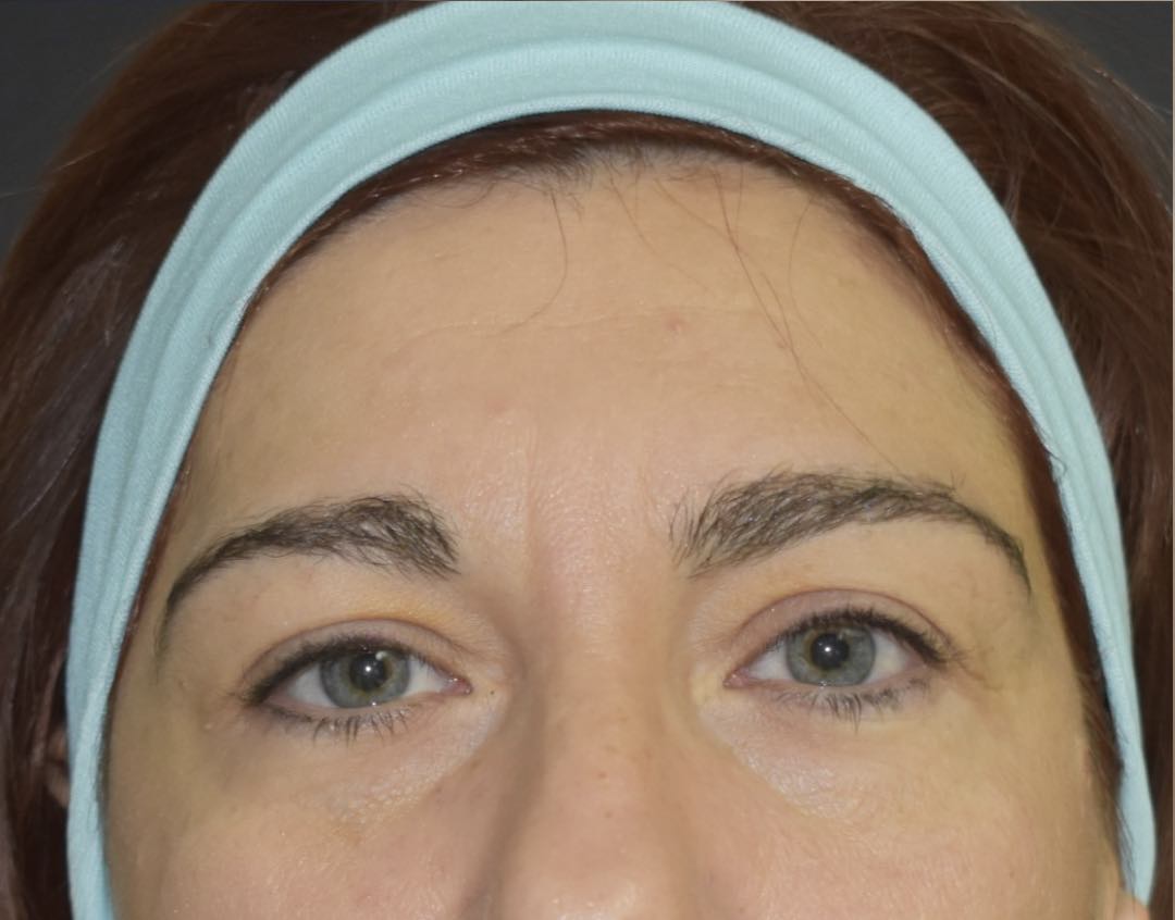 Blefaroplastica Catania