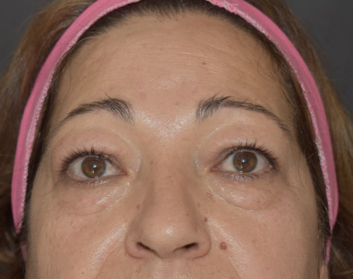 Blafaroplastica supero-inferiore a Catania