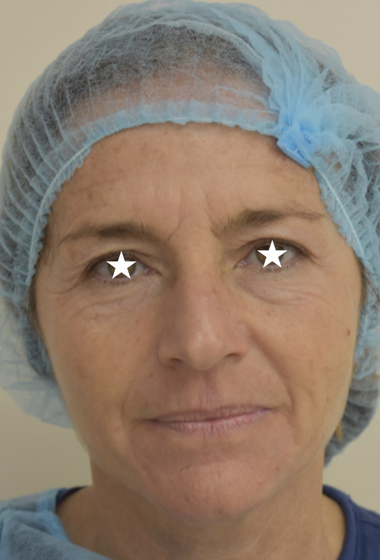 Blefaroplastica a Catania