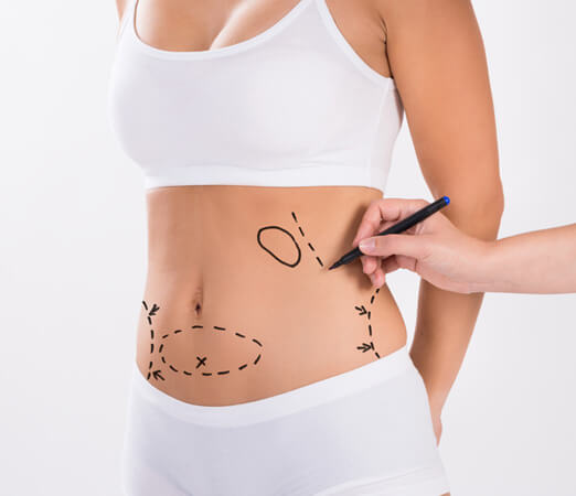 liposcultura catania