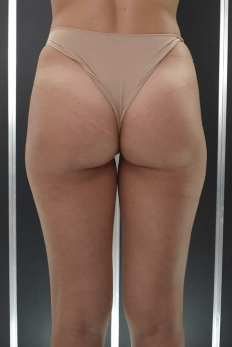 gluteoplastica catania