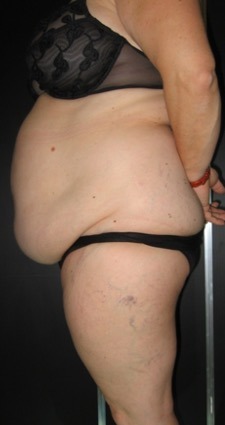 addominoplastica catania