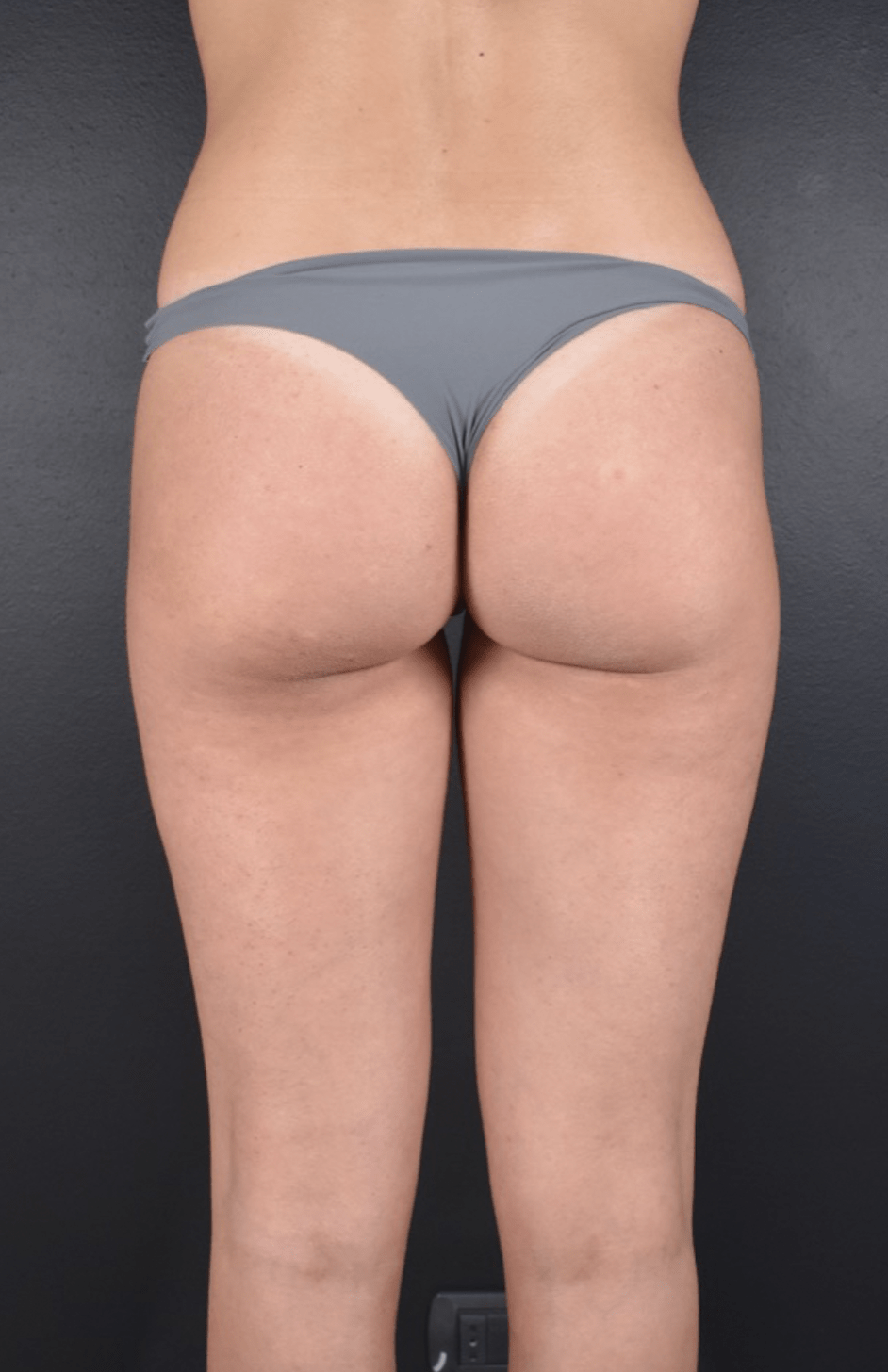 gluteoplastica catania