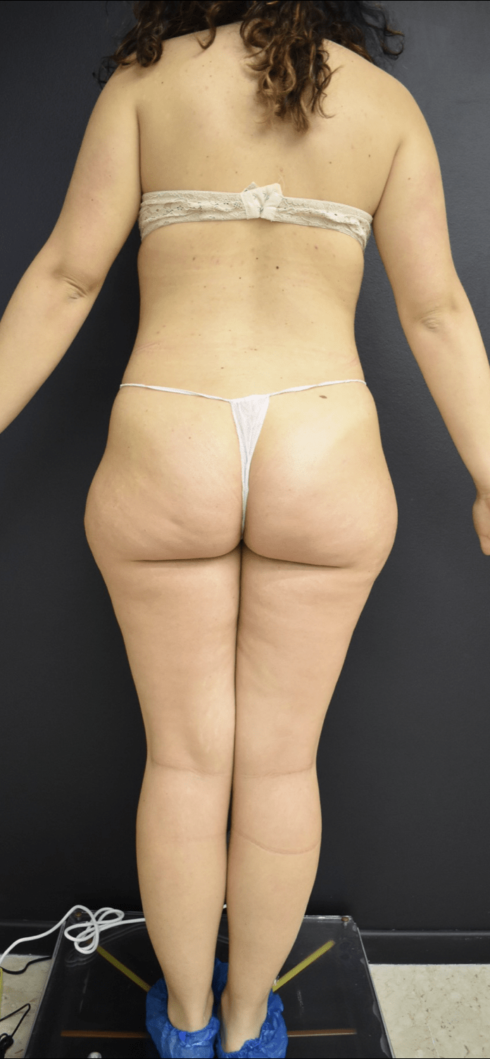 Liposuzione Catania Majani