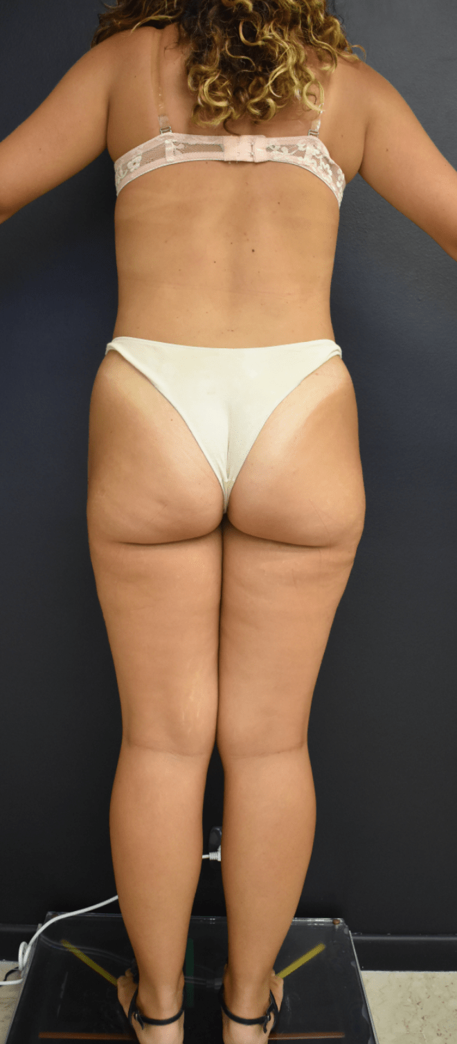 Liposuzione Chirurgia Plastica Catania