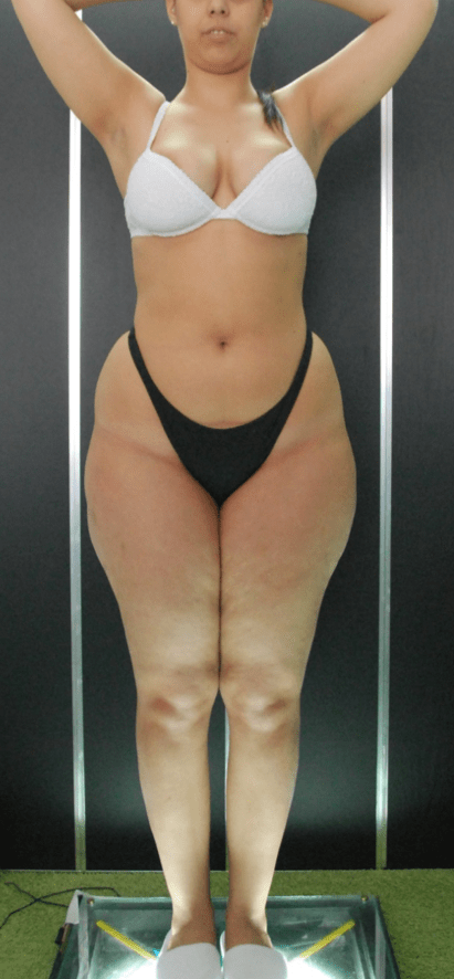 Liposuzione vaser Catania